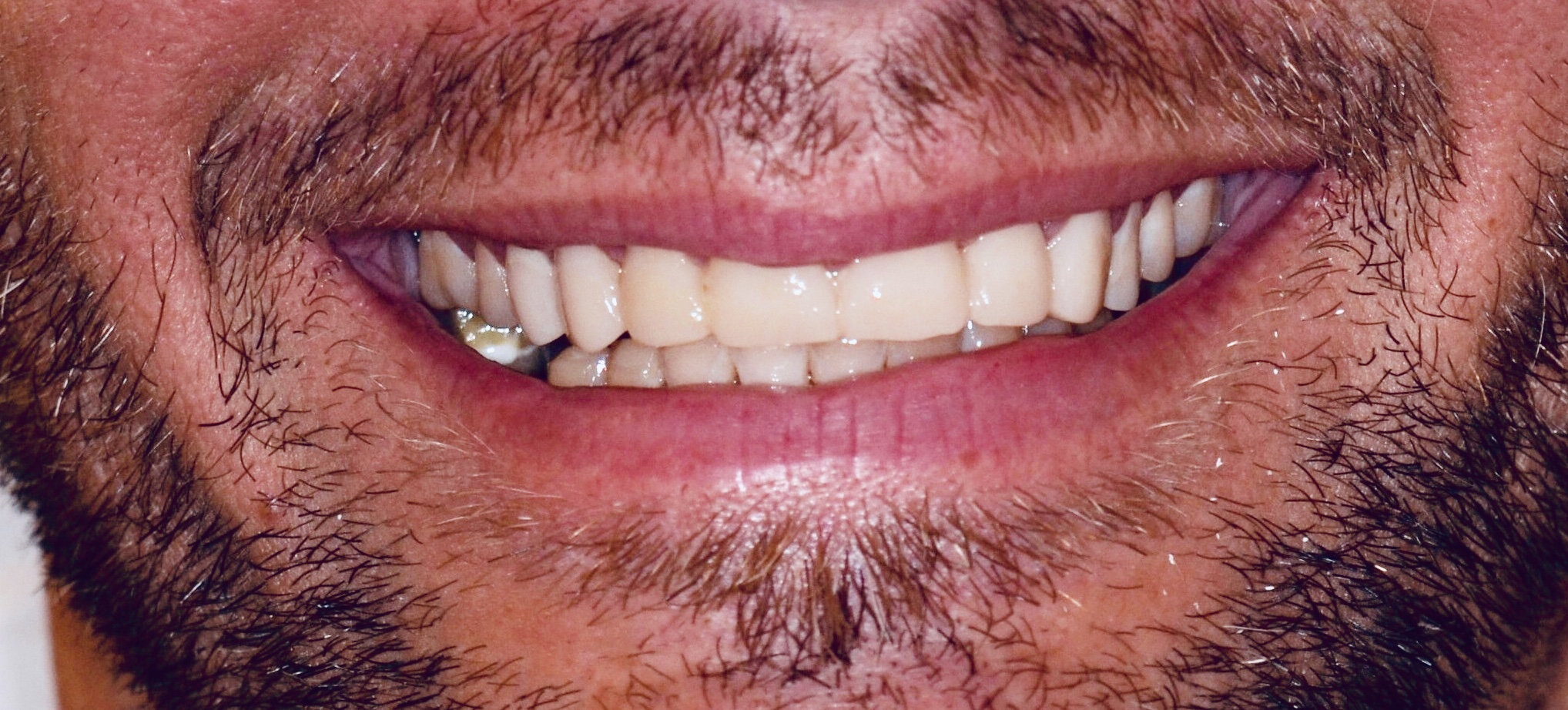 Why See A Prosthodontist? Chevy Chase MD